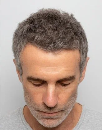 After GFC Hair Therapy at Varadhi Hair N Glow