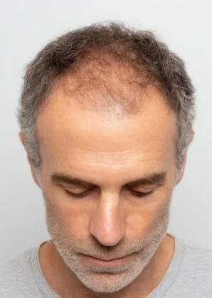 Before GFC Hair Therapy at Varadhi Hair N Glow