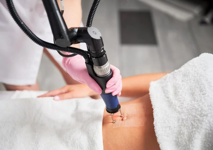 Stretch marks removal treatment explanation at Varadhi Hair N Glow Hair Transplant & Skin Laser Clinic, Vijayawada, Andhra Pradesh