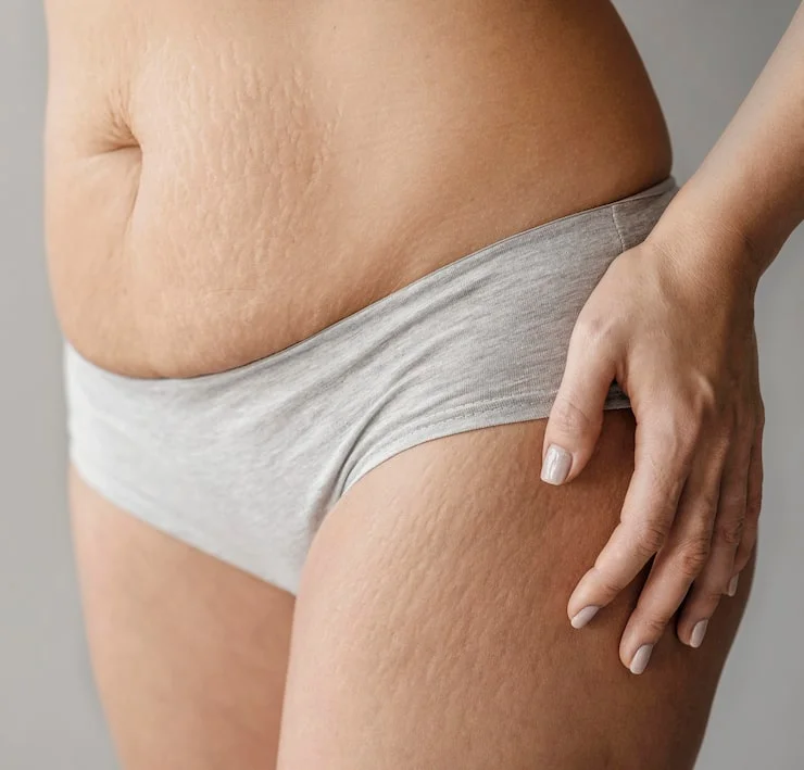Stretch marks removal FAQ at Varadhi Hair N Glow Hair Transplant & Skin Laser Clinic, Vijayawada, Andhra Pradesh