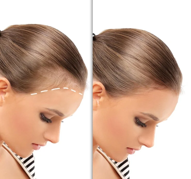 Female hair transplant procedure explanation at Varadhi Hair N Glow Hair Transplant & Skin Laser Clinic, Vijayawada, Andhra Pradesh