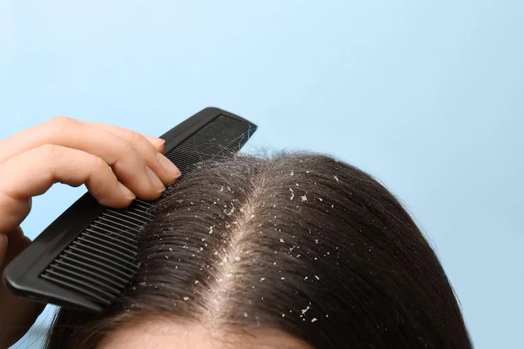 Anti-dandruff treatment at Varadhi Hair N Glow Hair Transplant & Skin Laser Clinic, Vijayawada, Andhra Pradesh
